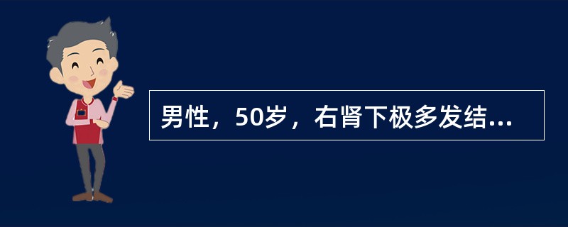 男性，50岁，右肾下极多发结石，左输尿管上段结石直径1.5cm。IVP示右肾下极