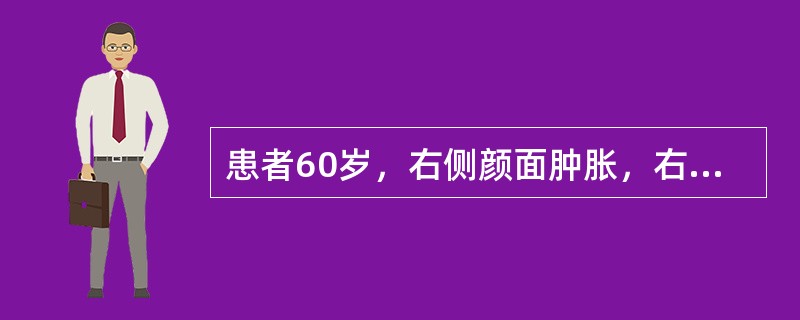 患者60岁，右侧颜面肿胀，右眼球渐突出5个月。CT显示右上颌窦腔增大，窦壁变薄伴