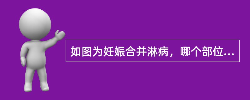 如图为妊娠合并淋病，哪个部位感染淋菌最为多见()