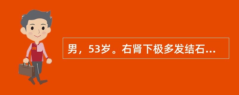 男，53岁。右肾下极多发结石，左输尿管上段结石直径15cm。静脉肾盂造影（IVP