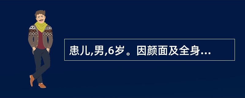 患儿,男,6岁。因颜面及全身水肿就诊,门诊以“肾病综合征”收入院。查体:面部、腹