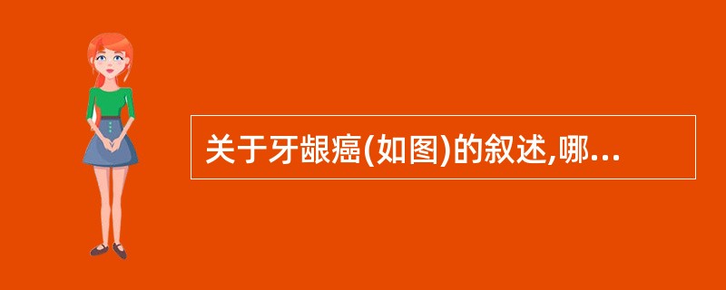 关于牙龈癌(如图)的叙述,哪项是错误的 ( )A、多为鳞状细胞癌B、男性多于女性