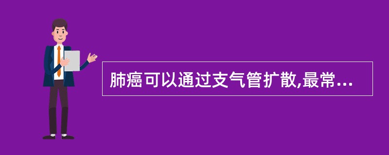 肺癌可以通过支气管扩散,最常见于A、鳞癌B、未分化小细胞癌C、大细胞癌D、支气管