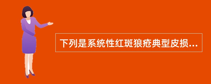 下列是系统性红斑狼疮典型皮损的是A、盘状红斑B、蝶形红斑C、结节红斑D、荨麻疹E