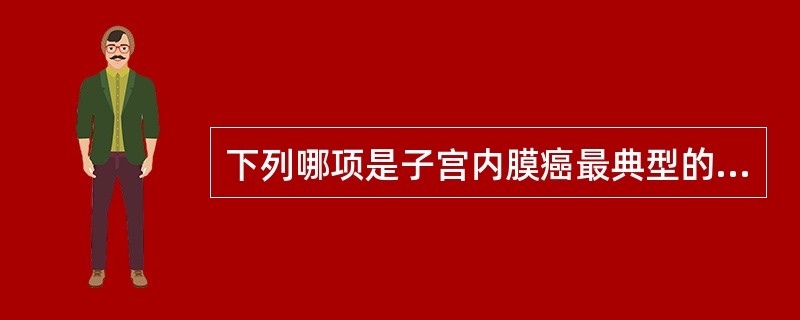 下列哪项是子宫内膜癌最典型的临床症状?( )A、不规则阴道流血B、血性白带C、痛