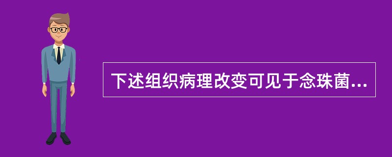 下述组织病理改变可见于念珠菌性白斑的是A、桑葚样细胞B、气球样细胞C、淋巴样滤泡