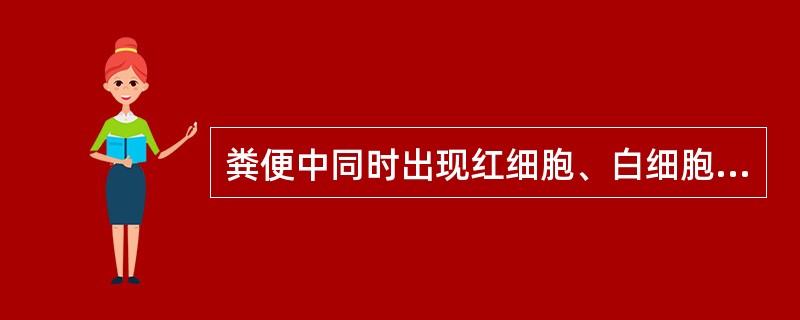 粪便中同时出现红细胞、白细胞和巨噬细胞最可能是A、溃疡性结肠炎B、十二指肠炎C、