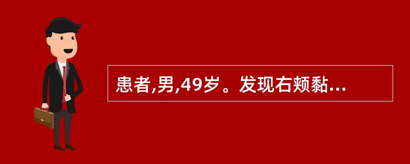 患者,男,49岁。发现右颊黏膜白色斑块3个月。检查:右颊白色斑块表面光滑,稍高出