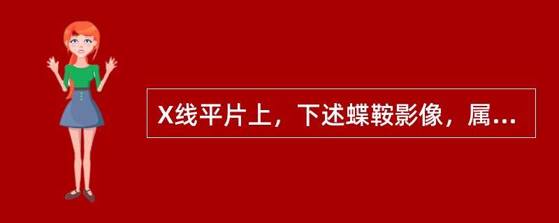 X线平片上，下述蝶鞍影像，属于正常蝶鞍影像的是()