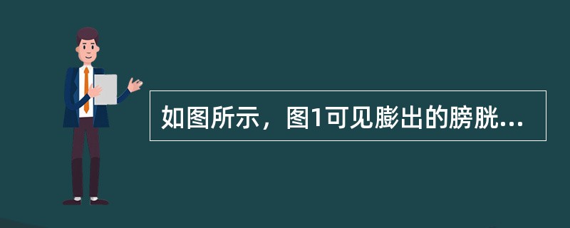 如图所示，图1可见膨出的膀胱随同阴道前壁仍位于阴道内，称________膨出；图