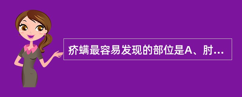 疥螨最容易发现的部位是A、肘窝B、手指间C、腋窝D、腹股沟E、腘窝