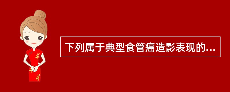 下列属于典型食管癌造影表现的是A、食管壁柔软B、食管腔狭窄C、食管黏膜连续D、食