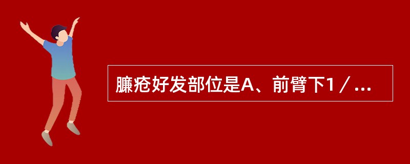 臁疮好发部位是A、前臂下1／3B、小腿下1／3C、臀部下1／3D、足部E、以上都