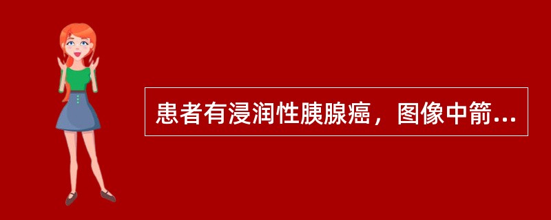 患者有浸润性胰腺癌，图像中箭头所指的管状物是()