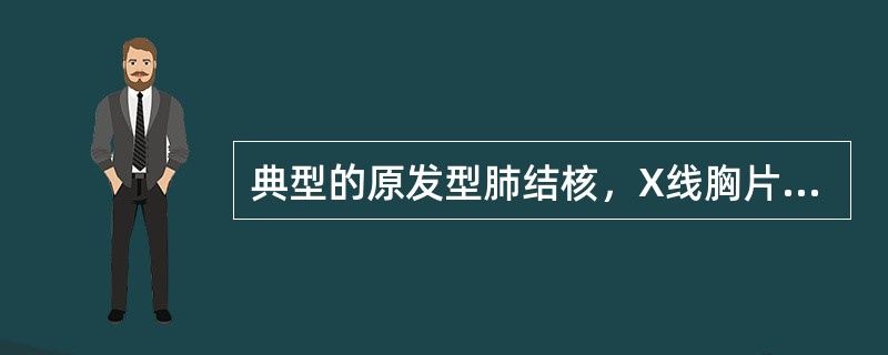 典型的原发型肺结核，X线胸片表现为（）