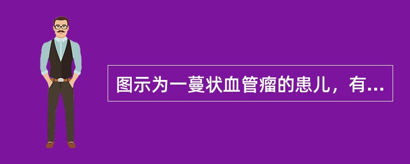 图示为一蔓状血管瘤的患儿，有关此病的描述不正确的是（）