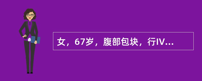 女，67岁，腹部包块，行IVP和CT检查如图，应诊断为（）.