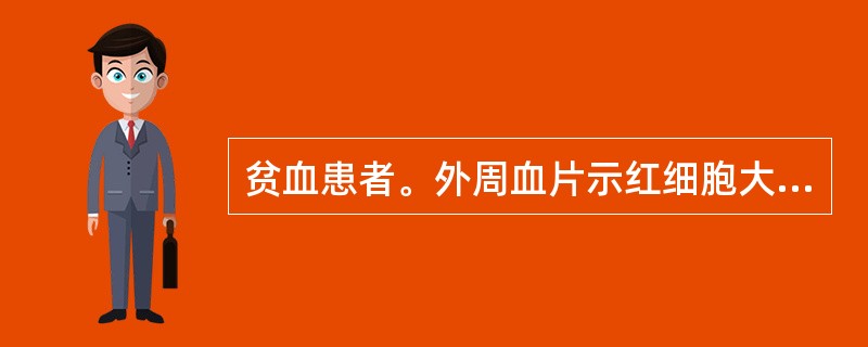 贫血患者。外周血片示红细胞大小不等，中央淡染区扩大。血清铁降低，转铁蛋白饱和度降