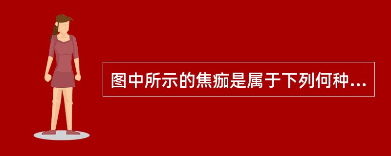 图中所示的焦痂是属于下列何种疾病的特征性体征()