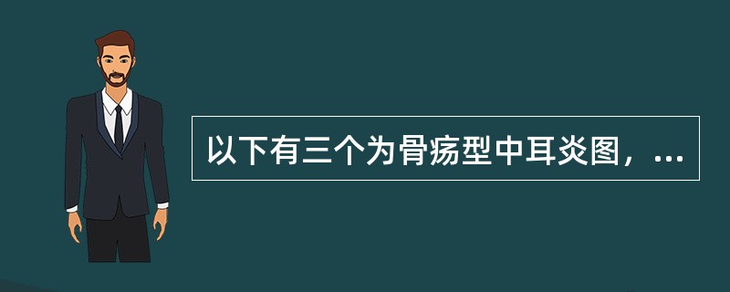 以下有三个为骨疡型中耳炎图，哪一选项为胆脂瘤性中耳炎（）。