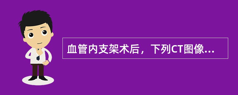 血管内支架术后，下列CT图像提示下列哪项诊断()