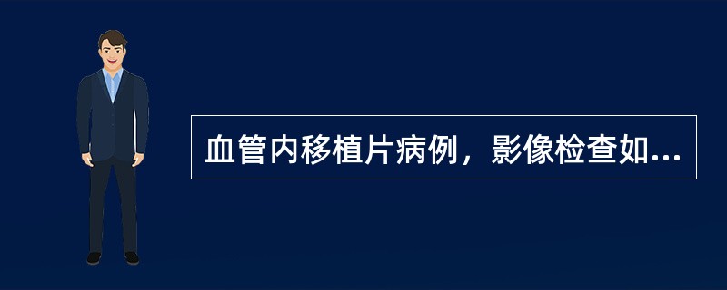 血管内移植片病例，影像检查如图所示，最可能的诊断为()