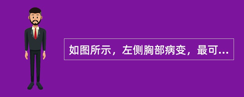 如图所示，左侧胸部病变，最可能的诊断为()