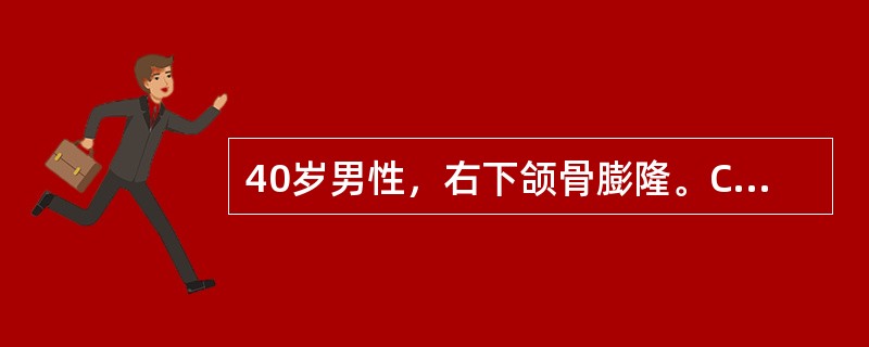 40岁男性，右下颌骨膨隆。CT示右下颌角有一2.5cm×3．0cm囊实性肿块，分