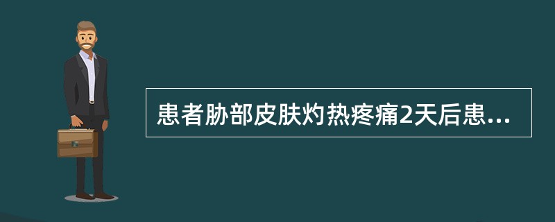 患者胁部皮肤灼热疼痛2天后患部皮肤出现簇集粟粒大小丘状疱疹，呈带状排列，疱壁紧张