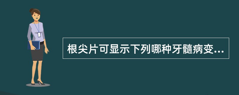 根尖片可显示下列哪种牙髓病变A、牙髓钙化B、牙髓坏死C、急性牙髓炎D、牙髓充血E