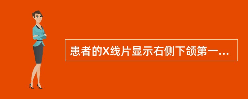 患者的X线片显示右侧下颌第一前磨牙根尖区的骨质破坏形成透射区，形态规则，呈圆形，