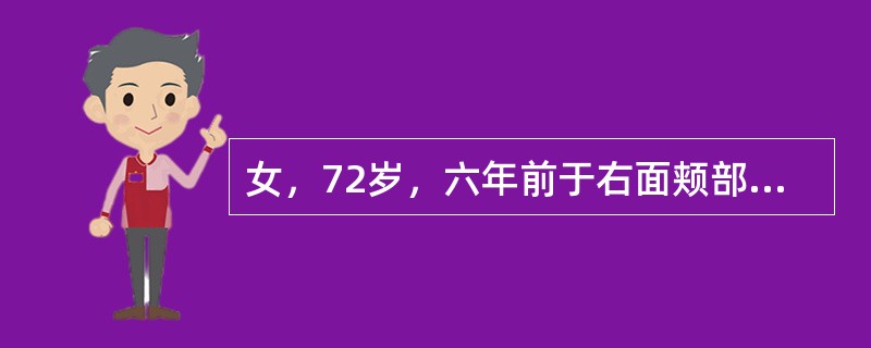 女，72岁，六年前于右面颊部扪及一包块，缓慢增大，其表面较光滑，CT如图所示，该