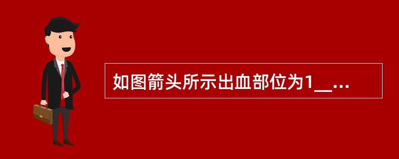 如图箭头所示出血部位为1____________2___________。