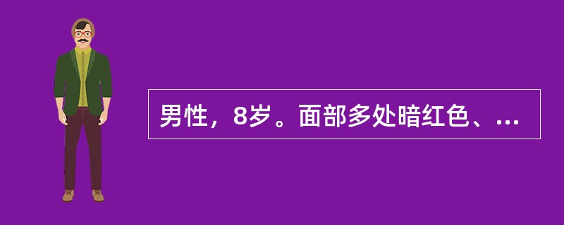 男性，8岁。面部多处暗红色、大小不等、形状不规则的扁平斑片，不高出皮面，用手压之