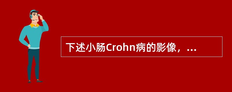 下述小肠Crohn病的影像，应除外（）。