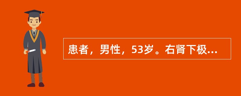 患者，男性，53岁。右肾下极多发结石，左输尿管上段结石直径15cm。静脉肾盂造影