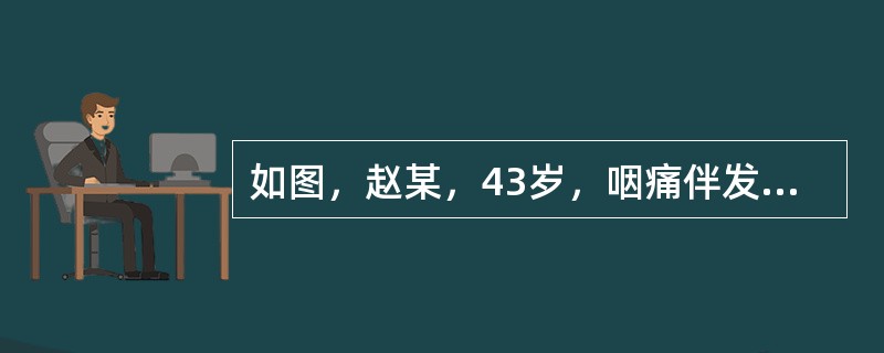 如图，赵某，43岁，咽痛伴发热、头痛2天就诊，T38.3℃，检查见口咽粘膜急性充