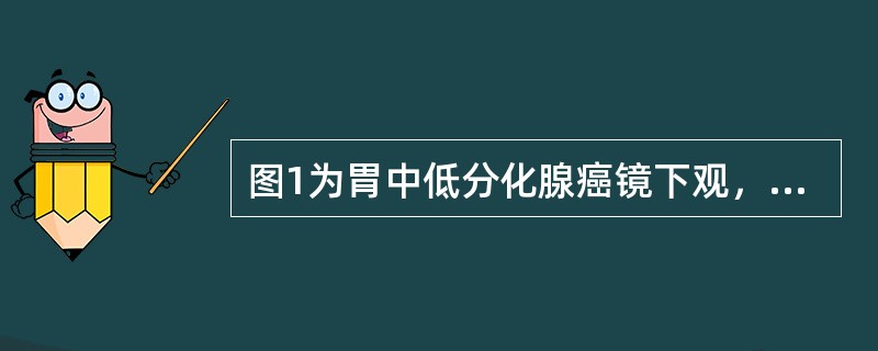 图1为胃中低分化腺癌镜下观，图2为甲状腺滤泡癌镜下观，箭头所指表示了肿瘤的哪几种