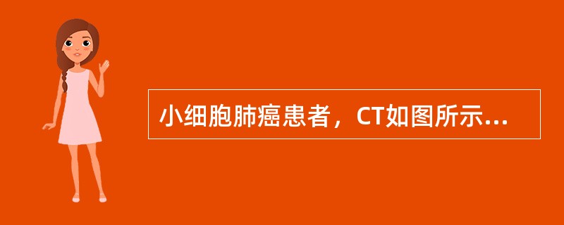 小细胞肺癌患者，CT如图所示，最可能的诊断为()