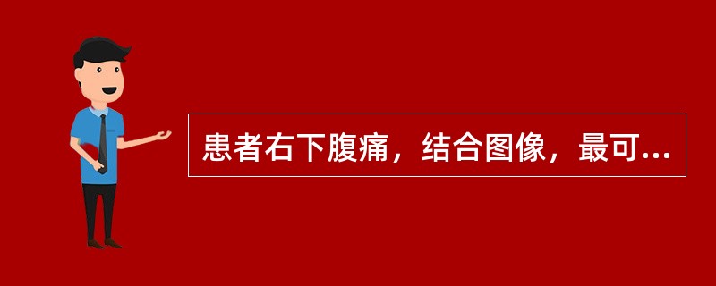 患者右下腹痛，结合图像，最可能的诊断为()