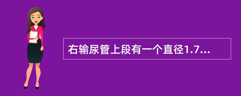 右输尿管上段有一个直径1.7cm结石，左输尿管上段有一直径1cm结石，排泄性尿路