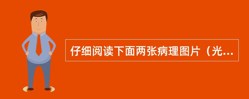 仔细阅读下面两张病理图片（光镜下毛细血管袢呈铁丝圈样—白金耳），其诊