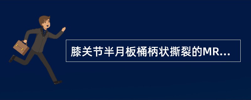 膝关节半月板桶柄状撕裂的MRI表现,正确的是