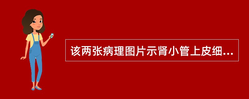 该两张病理图片示肾小管上皮细胞脱落，其诊断为()