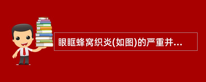眼眶蜂窝织炎(如图)的严重并发症有()<img border="0" style="width: 222px; height: 167px;" src=&