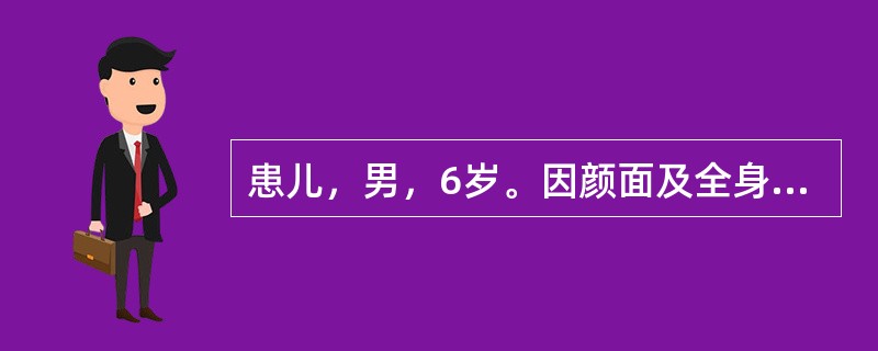 患儿，男，6岁。因颜面及全身水肿就诊，门诊以“肾病综合征”收入院。查体：面部、腹壁及双下肢明显水肿，呈凹陷性，腹部膨隆，腹水征(+)，阴囊明显水肿，囊壁变薄透亮呈球形。实验室检查：尿蛋白(++++)，