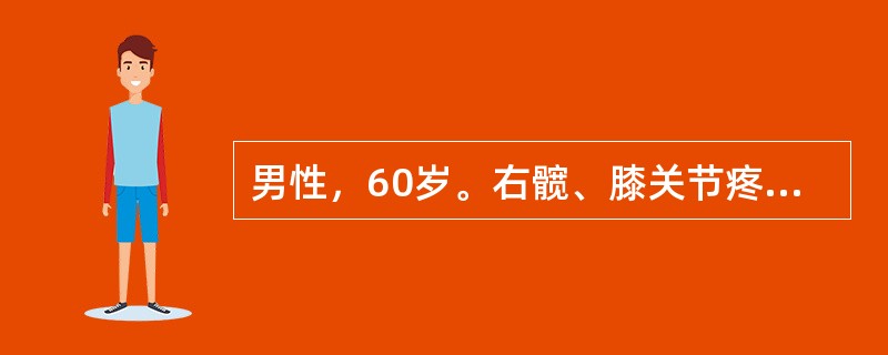 男性，60岁。右髋、膝关节疼痛2年，加重3个月。现感疼痛明显加重，休息后亦无明显缓解。晨起髋关节有僵硬感，一般活动15分钟后僵硬感消失。体格检查：右膝关节无异常体征。右髋关节屈曲位，右“4”字试验阳性