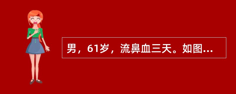 男，61岁，流鼻血三天。如图所示最可能的诊断为()<img border="0" style="width: 360px; height: 270px;"