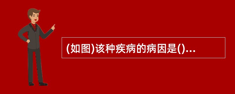 (如图)该种疾病的病因是()<img border="0" style="width: 269px; height: 202px;" src="