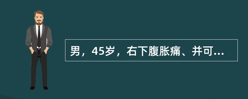 男，45岁，右下腹胀痛、并可触及质硬包块，请结合图像选择最可能诊断()<img border="0" style="width: 200px; height: 13